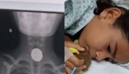 Criança engole moeda que caiu do bolso do pai em SP e médicos tiram objeto com ímã