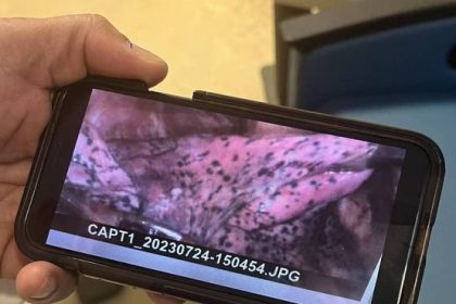 Lutador de MMA fica com pulmão manchado e remove parte do órgão por uso de vape