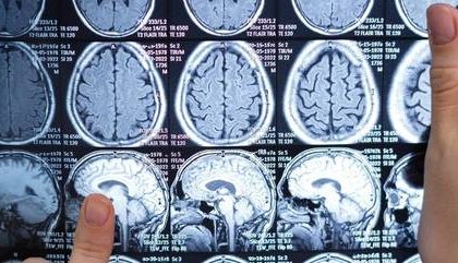 Remédio para ansiedade aumenta chances de sobrevivência de pacientes com câncer cerebral